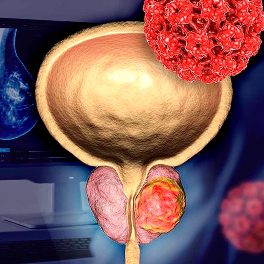 New scans that make prostate cancer cells glow