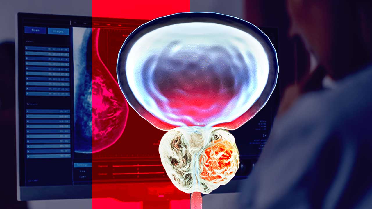 New scans that make prostate cancer cells glow