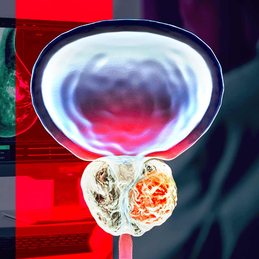 New scans that make prostate cancer cells glow