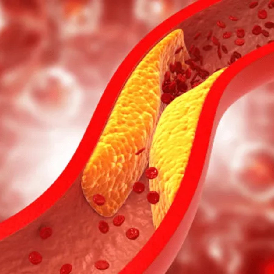 How to be alert whether your artery is aging in 30s dgtl