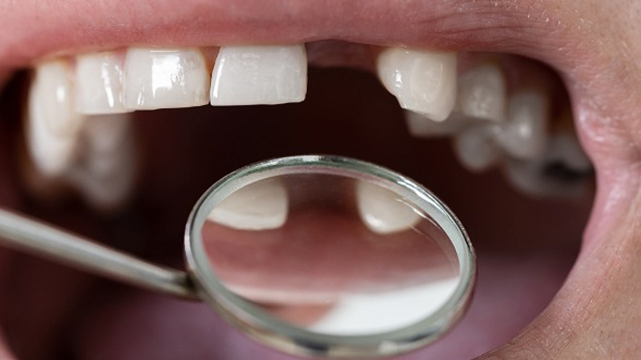 Researchers in Japan are testing a new drug that could allow people to regrow lost teeth