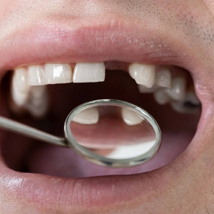 Researchers in Japan are testing a new drug that could allow people to regrow lost teeth