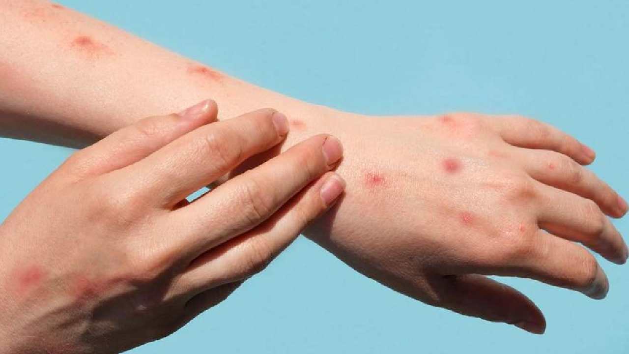 চিকেন পক্স, না কি সাধারণ র‌্যাশ তফাত করবেন কী করে?