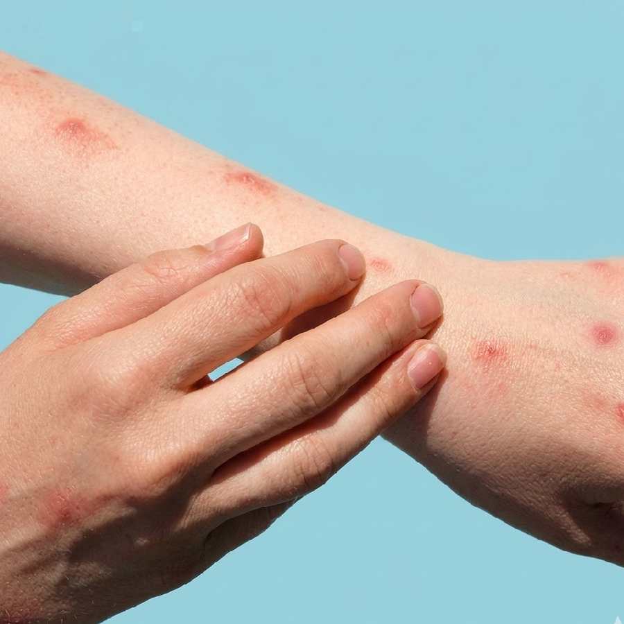 how to identify that the rash of your body is actually symptoms of chicken pox dgtl