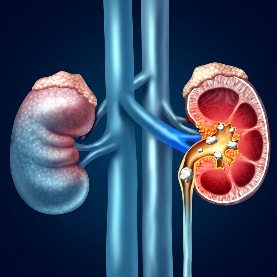 কিডনির ক্ষতি হতে পারে নিঃশব্দেই। কোন বিষয়গুলি কিডনির জন্য ঝুঁকিপ্রবণ?