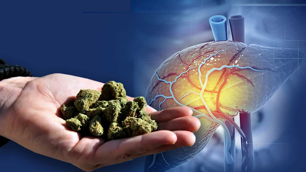 A new study suggests that non-intoxicating cannabis may fight Fatty Liver Disease