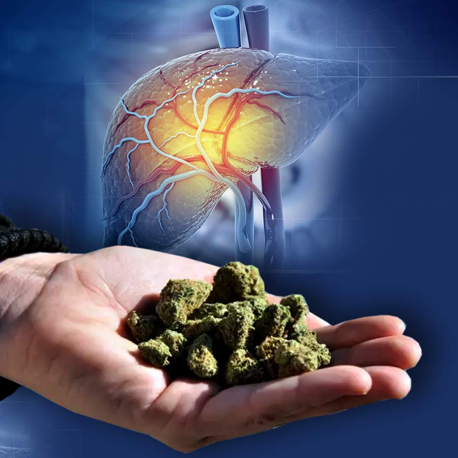 A new study suggests that non-intoxicating cannabis may fight Fatty Liver Disease