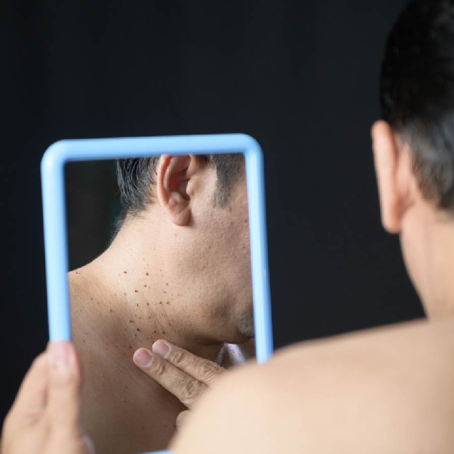 ঘাড়ের কালচে ছোপ হতে পারে জটিল অসুখের উপসর্গ।