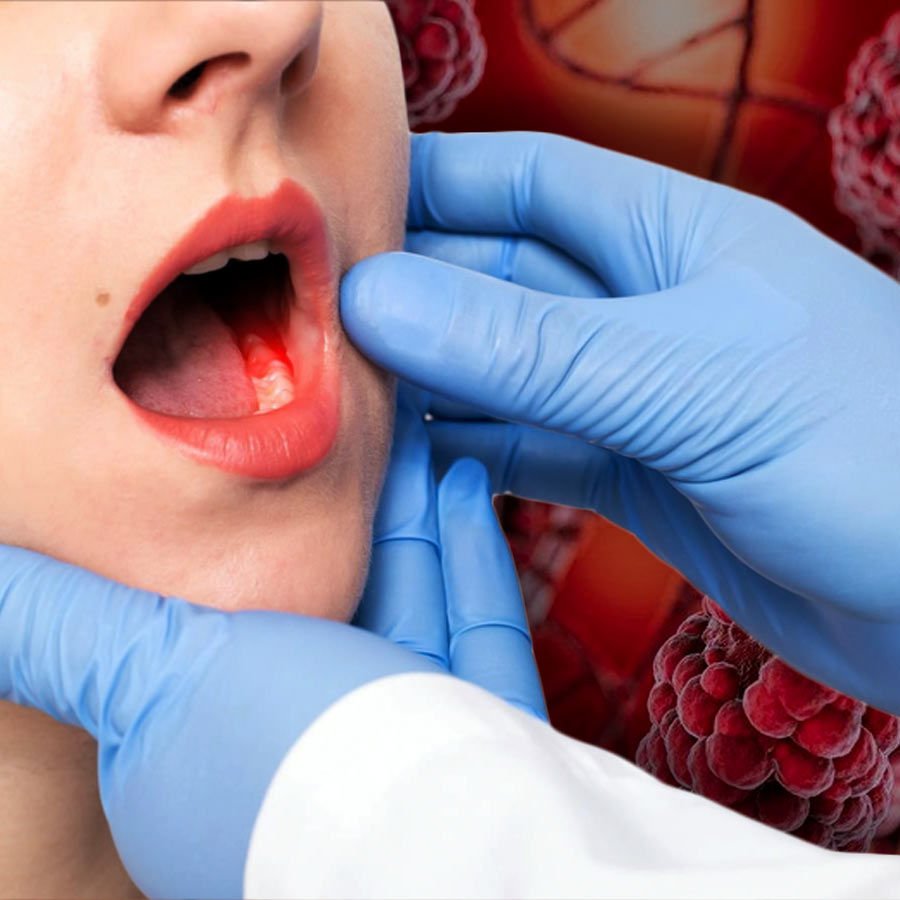 Silent Symptoms of oral cancer including mouth ulcer dgtl