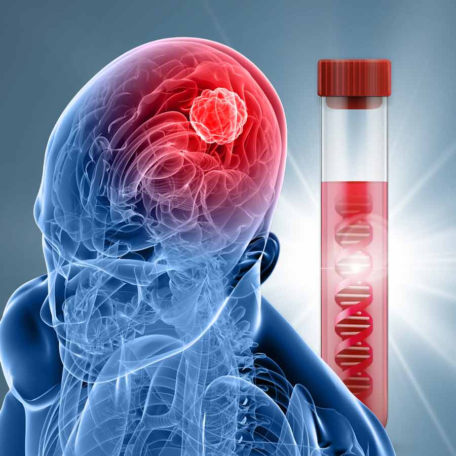 Scientists say a simple blood test could detect brain tumours very quickly