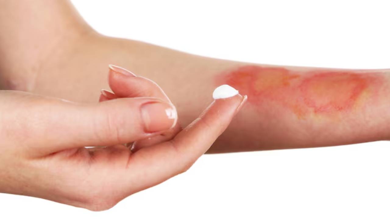 পুড়ে যাওয়া ক্ষতের জ্বালা কমবে কী উপায়ে, সহজ ঘরোয়া টোটকা।