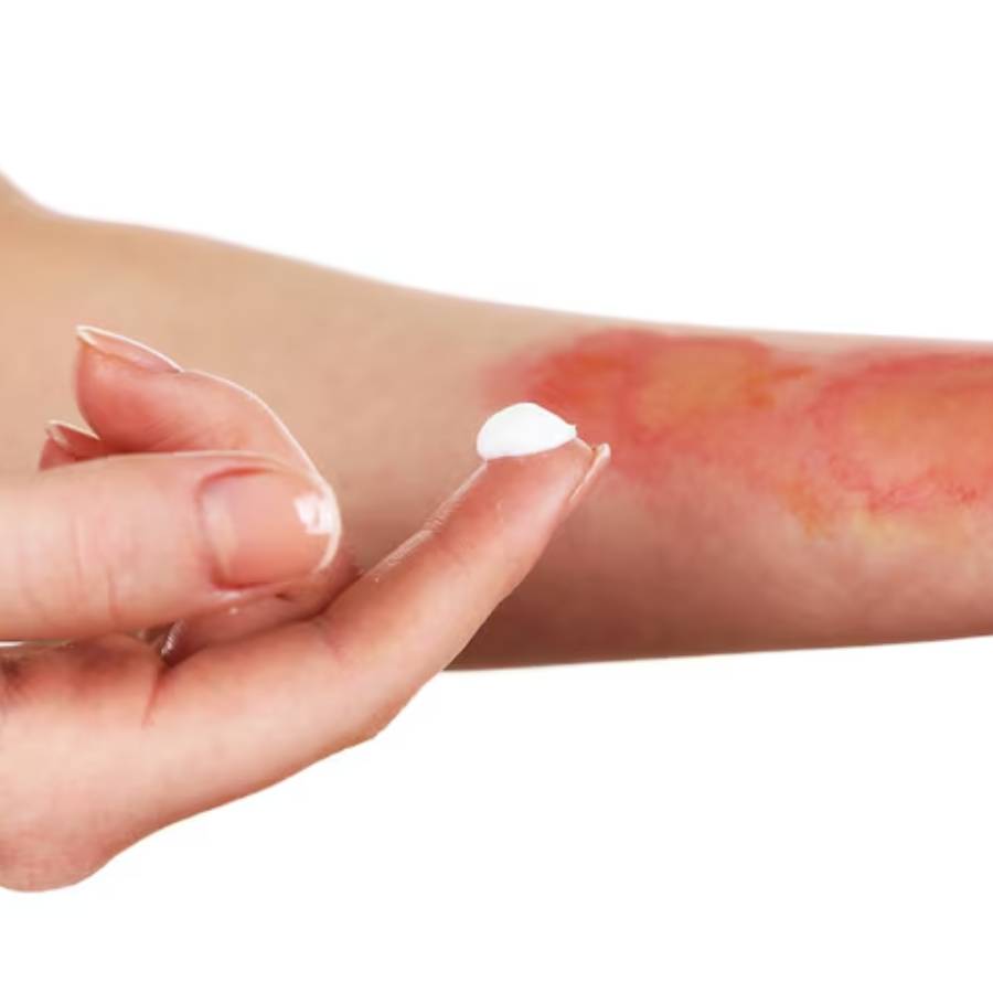 How to treat a burn injury at home dgtl