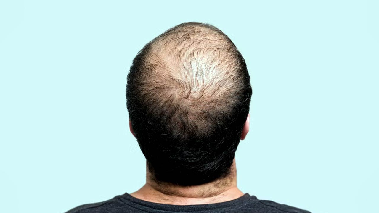 What is Triple-Threat Treatment for Hair Loss