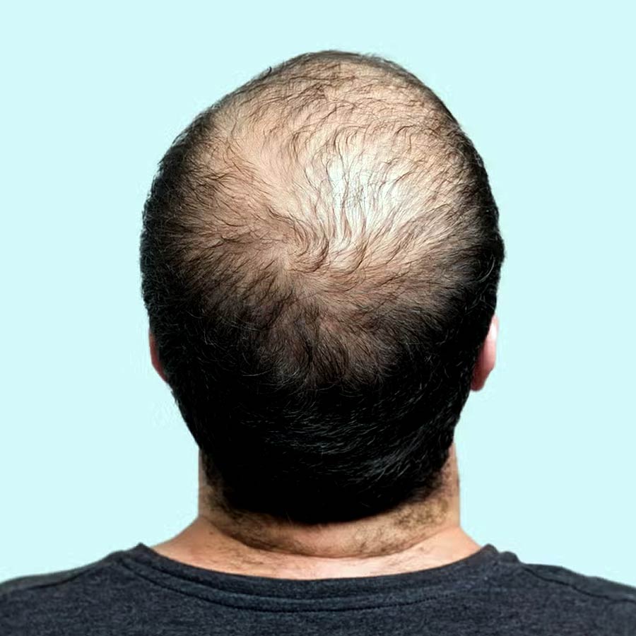 What is Triple-Threat Treatment for Hair Loss