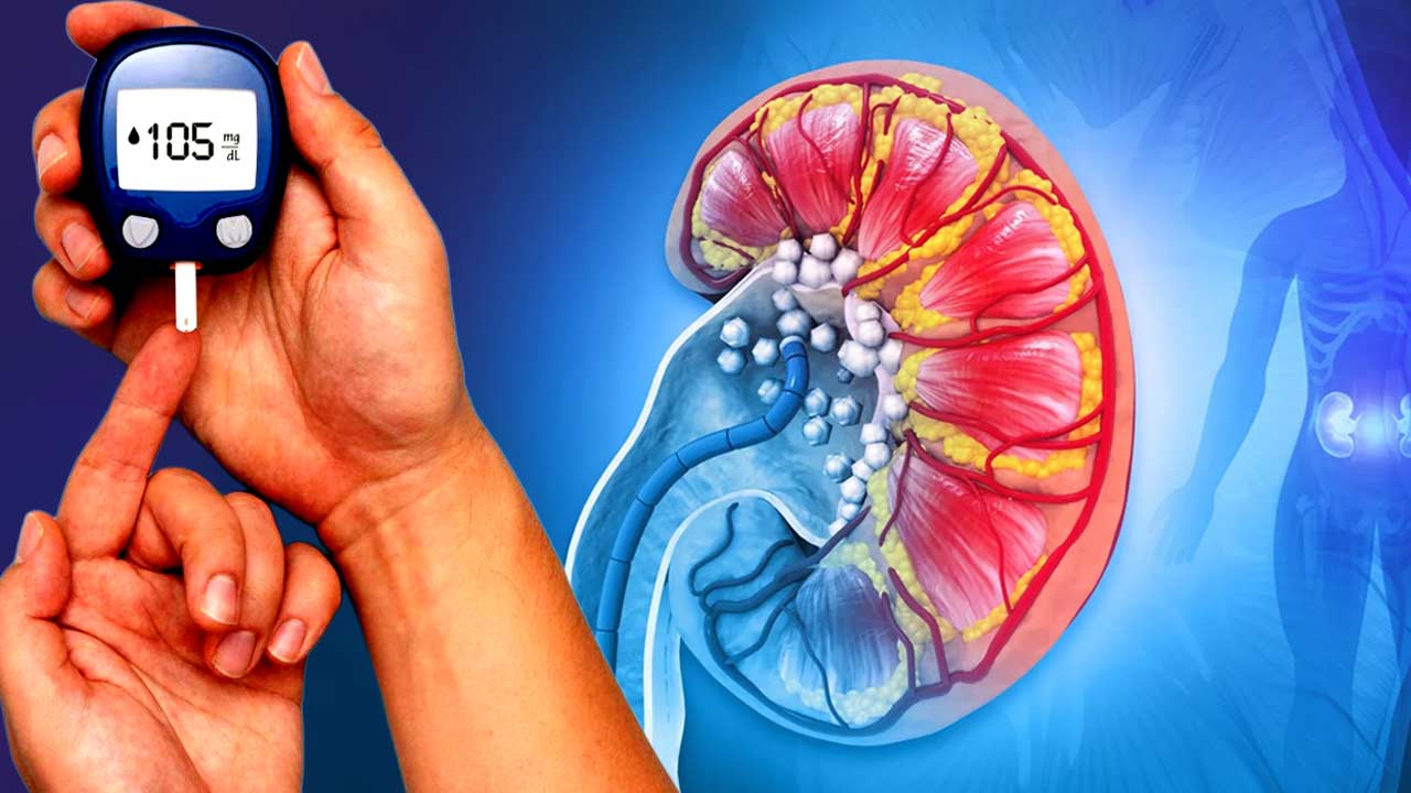 Diabetes patients should routinely perform three essential kidney tests to check for diabetic nephropathy