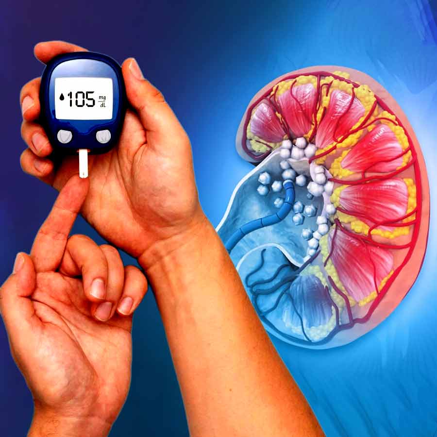 Diabetes patients should routinely perform three essential kidney tests to check for diabetic nephropathy