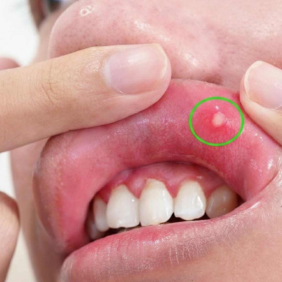 Reasons why stress can cause mouth ulcer dgtl