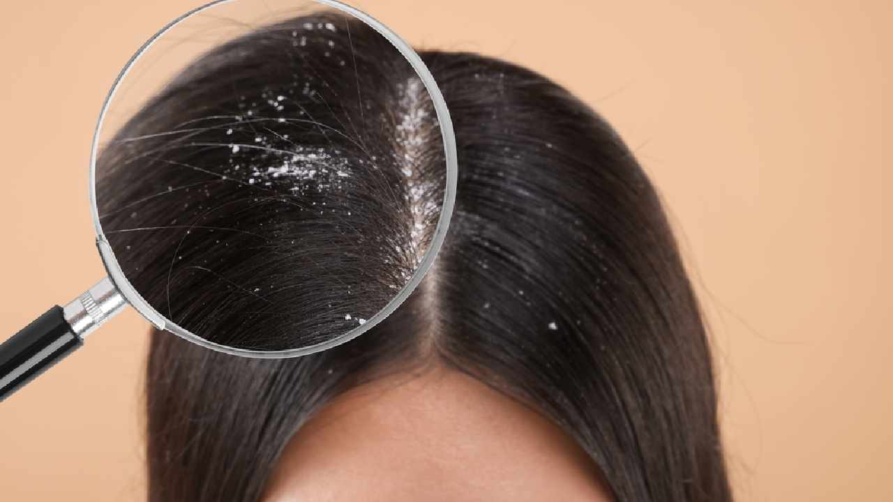 খুশকির শ্যাম্পুতে কোন উপাদানটি অবশ্যই থাকতে হবে?