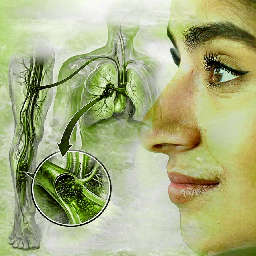 What is pulmonary embolism, what are the symptoms of this disease