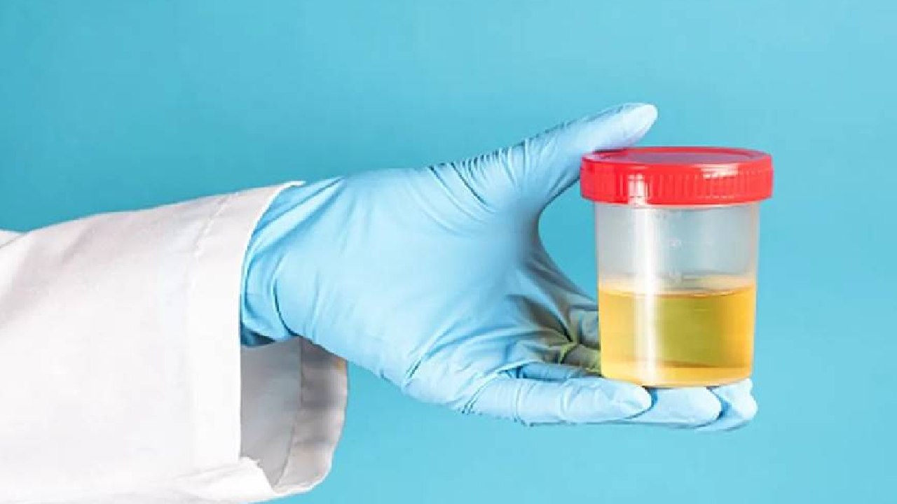 হলুদ প্রস্রাব কি ডায়াবিটিসের লক্ষণ?