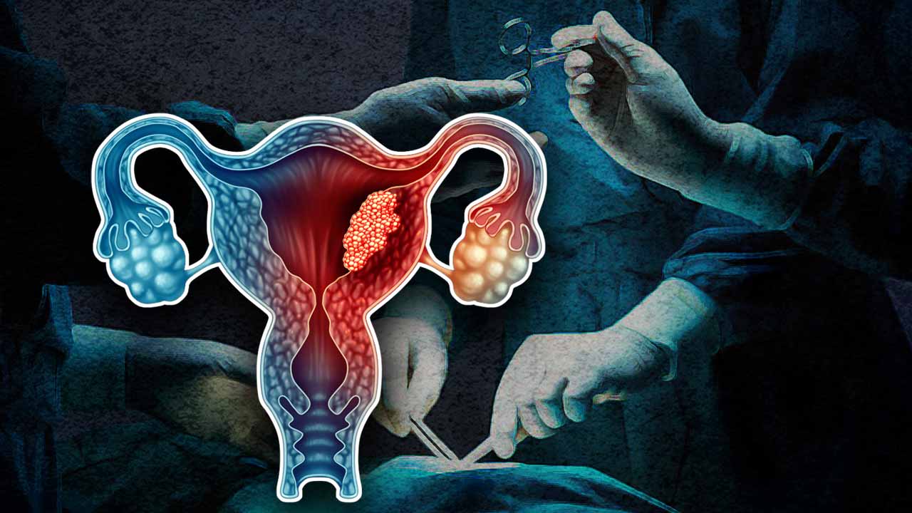 Doctors at AIIMS Delhi removed a massive uterine sarcoma tumour from a 46-year-old woman