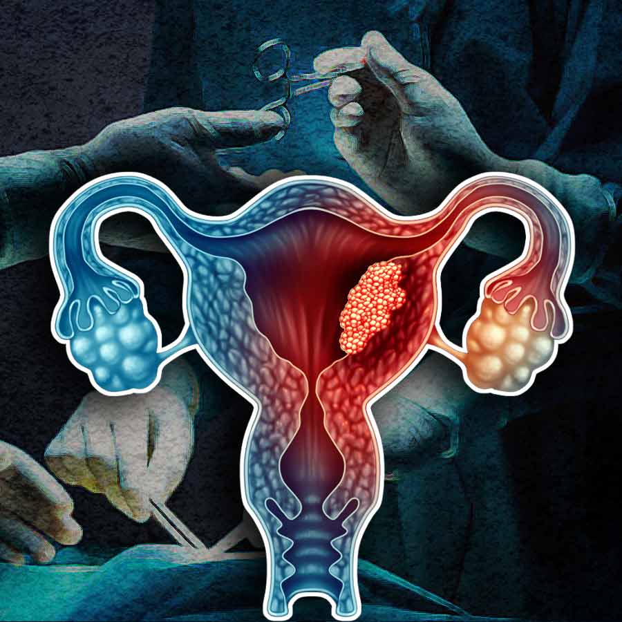 Doctors at AIIMS Delhi removed a massive uterine sarcoma tumour from a 46-year-old woman