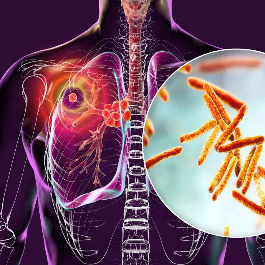 টিবির সঙ্গে লড়াই করার জন্য কী ভাবে প্রস্তুতি নেবেন।