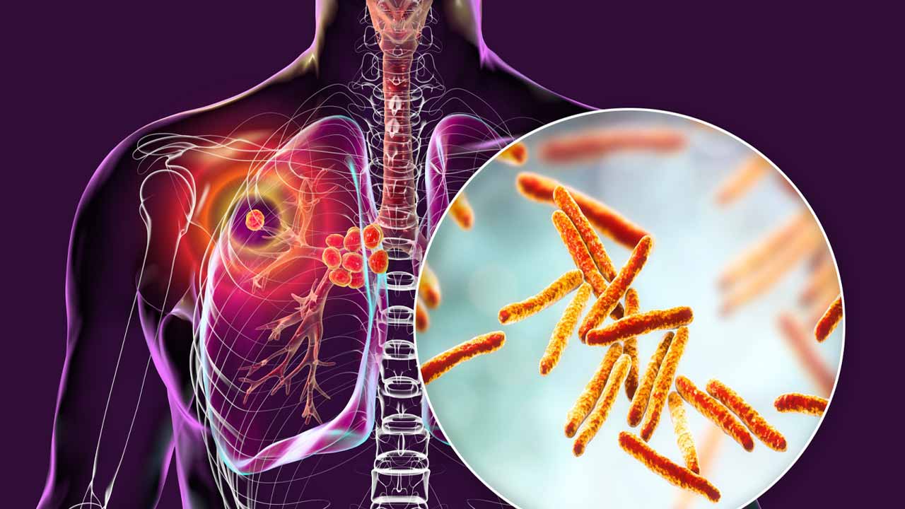 টিবির সঙ্গে লড়াই করার জন্য কী ভাবে প্রস্তুতি নেবেন।