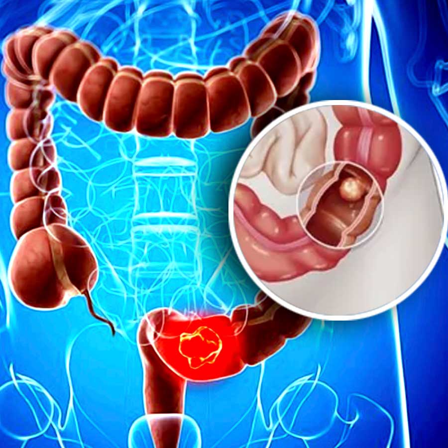 What is silent colon cancer which occurs on the right side dgtl