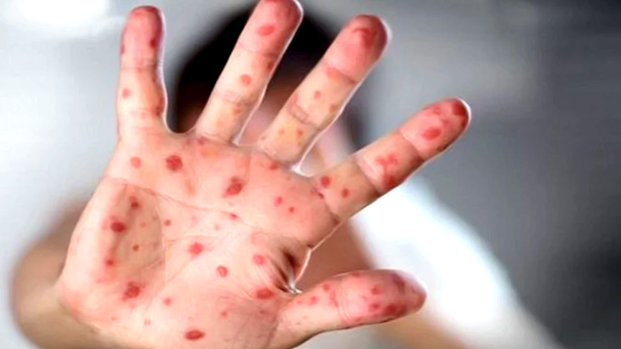 What are the symptoms of measles, how to protect children from measles outbreak