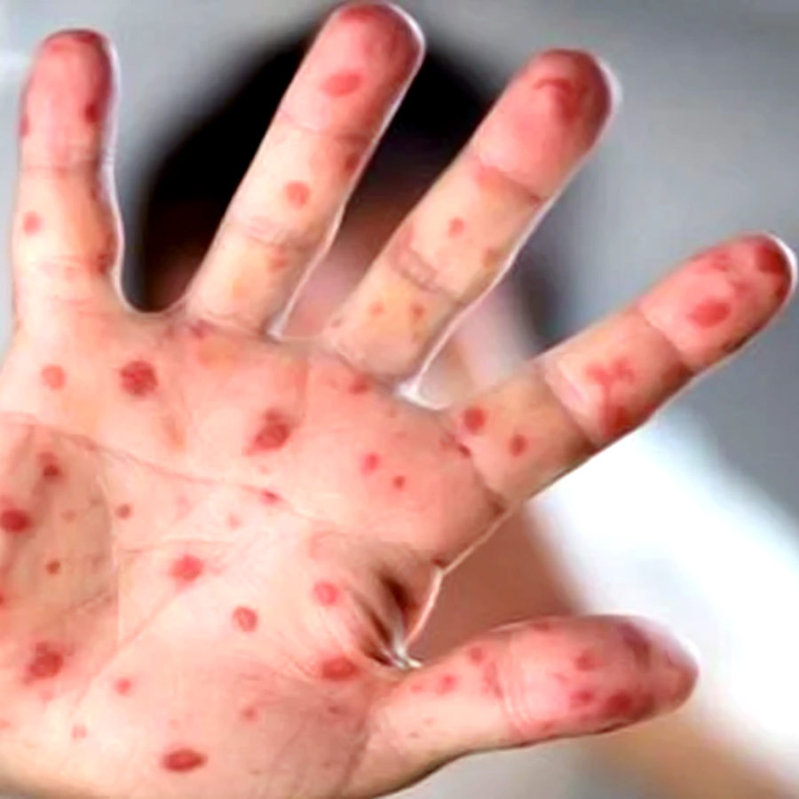 What are the symptoms of measles, how to protect children from measles outbreak