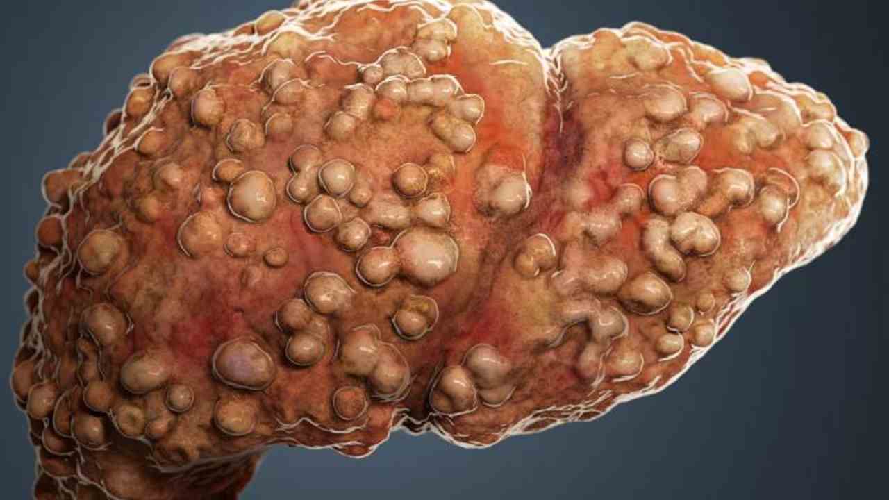 Find the risks of cirrhosis before it is too late