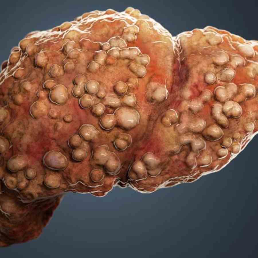 Find the risks of cirrhosis before it is too late