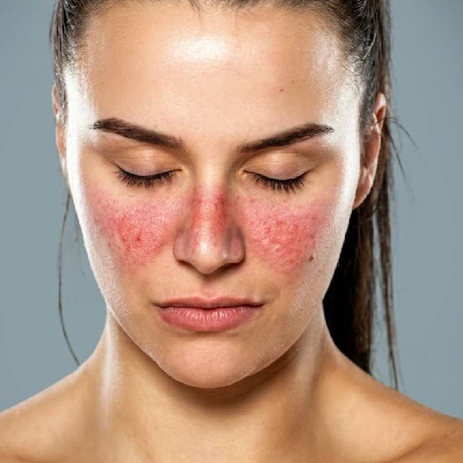 Symptoms of Lupus that one should not ignore dgtl