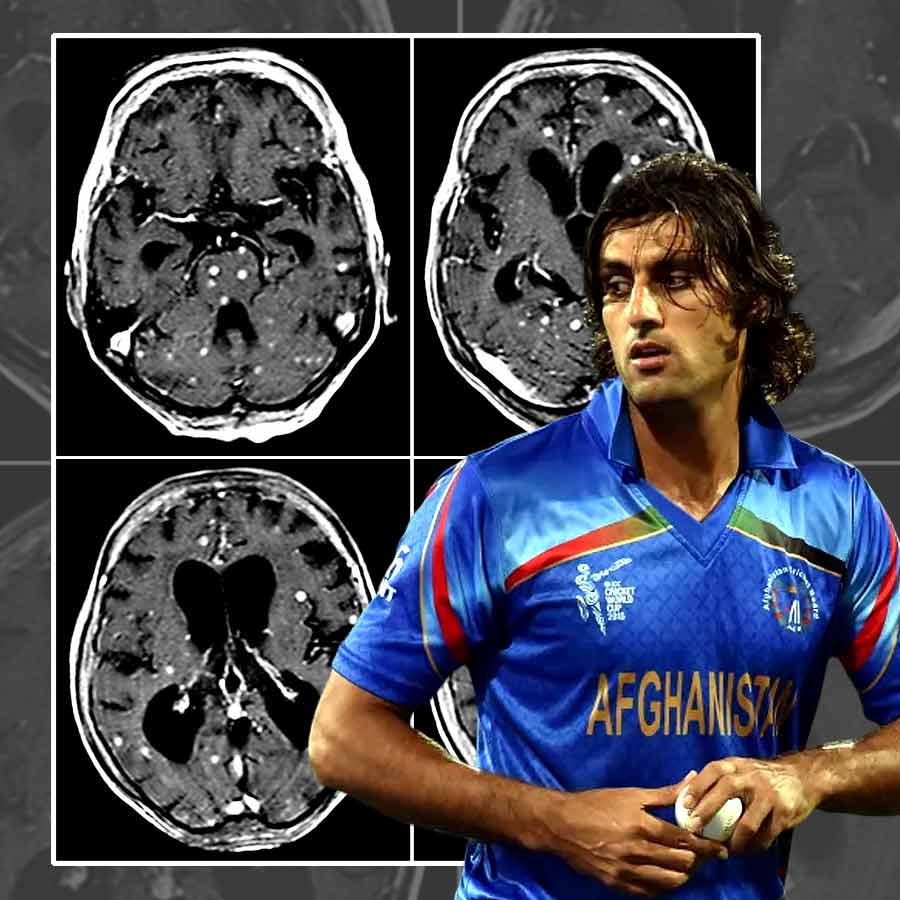 Former Cricketer Shapoor Zadran Battles Rare Immune Disorder hemophagocytic lymphohistiocytosis