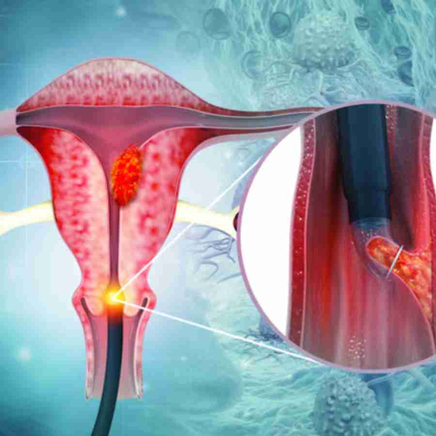 Cervical Cancer risks After 40, essential Screenings You Need