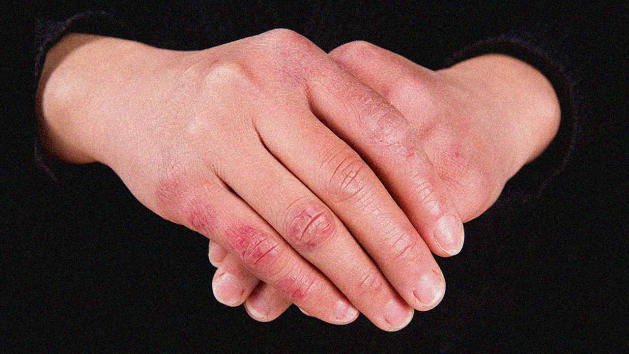 Summer Fungal Woes, shielding your skin from Seasonal Infections