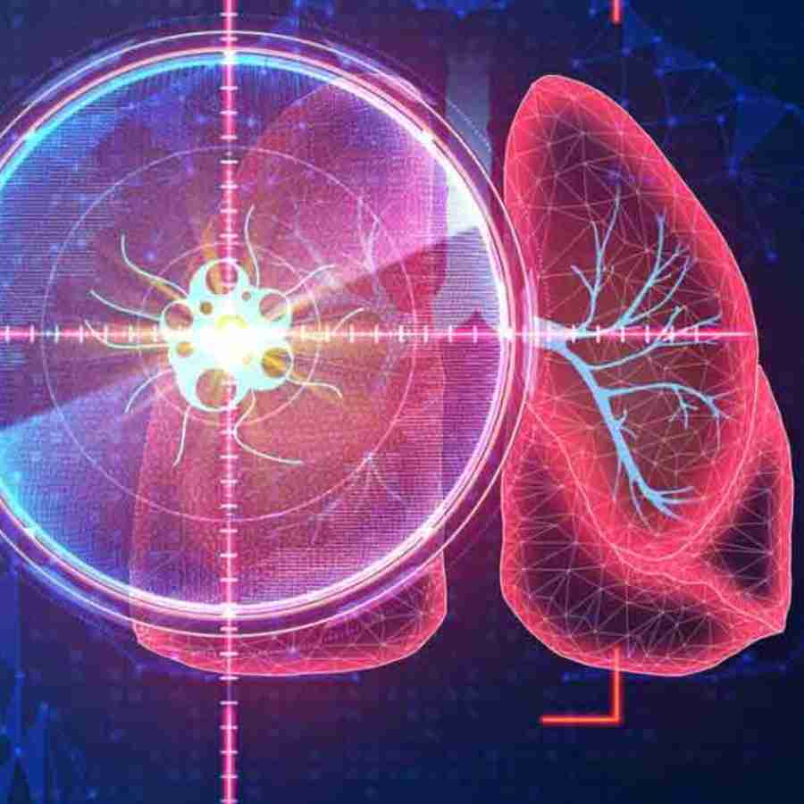India Introduces 7-Minute Cancer Immunotherapy Injection for Lung Cancer Patients