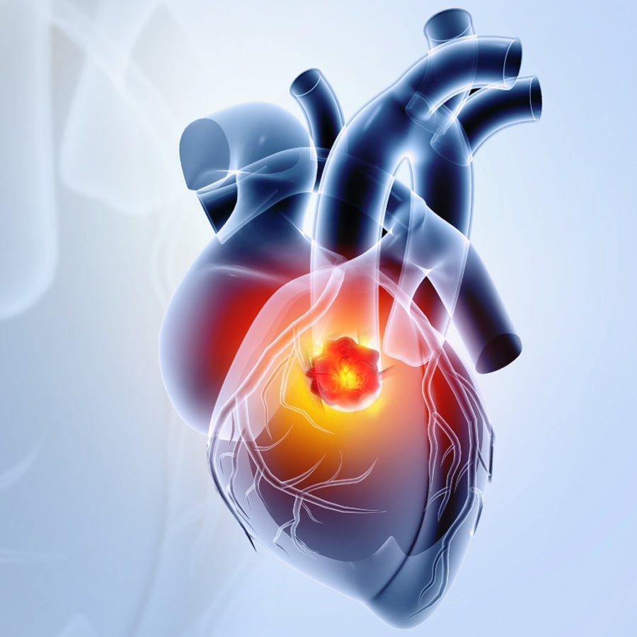 What is heart cancer, the Rare Disease Mimicking Heart Disease Signs