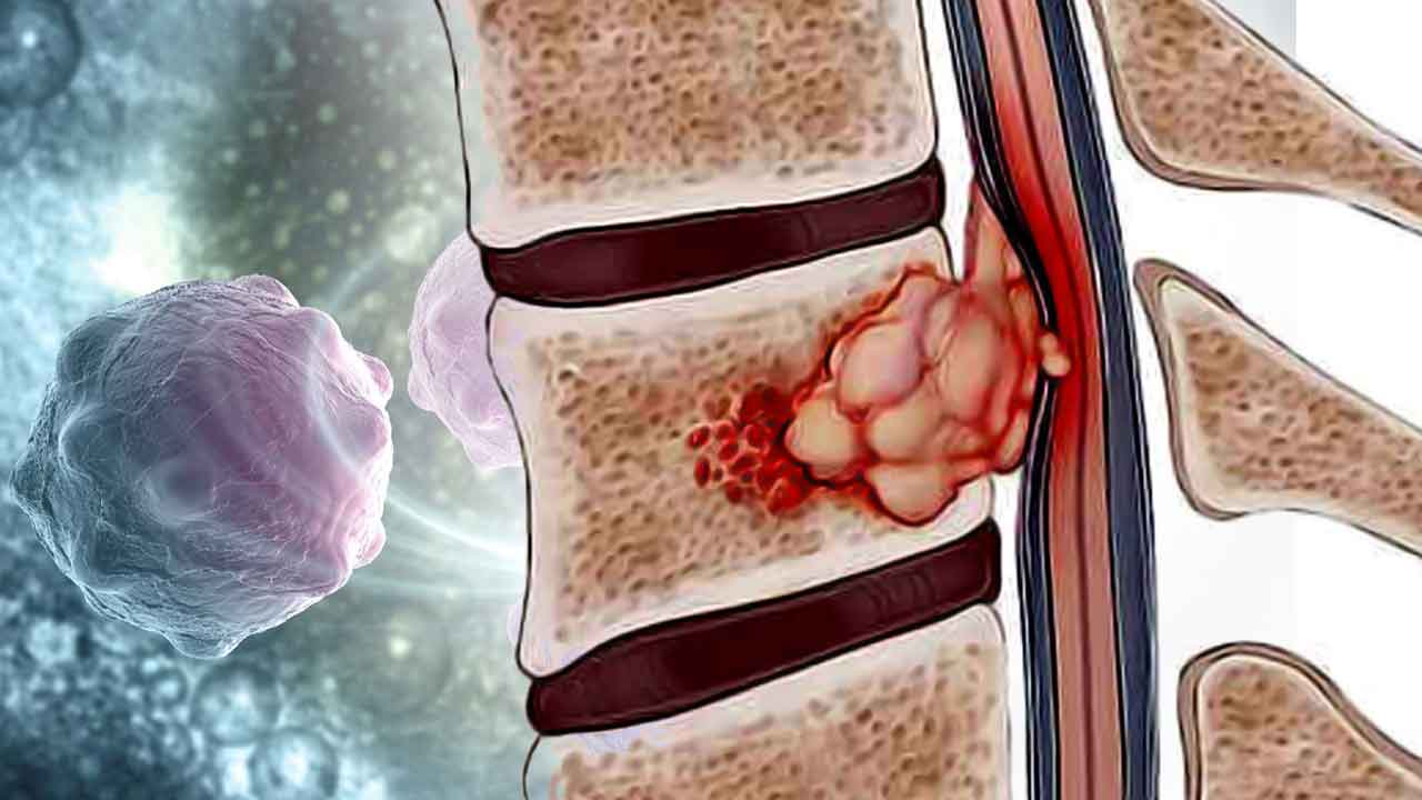 Chordoma the Rare Bone Cancer Lurking in the Spine and Shrouding the Sight