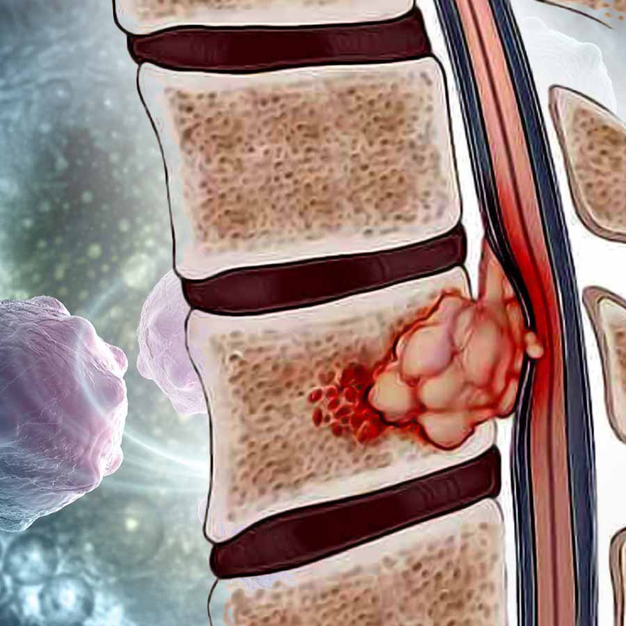 Chordoma the Rare Bone Cancer Lurking in the Spine and Shrouding the Sight