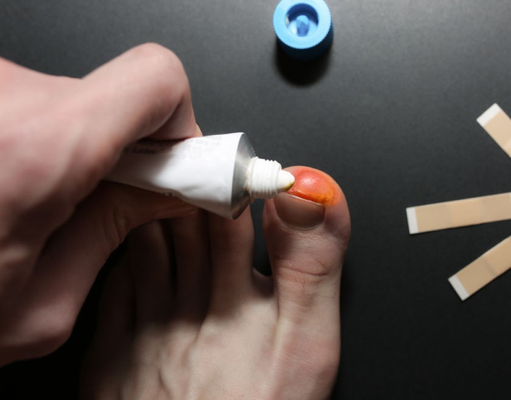 ভুল করেও ফোস্কা ফাটিয়ে ফেলবেন না। কোনও কারণে ফোস্কা ফেটে গেলে, তাতে অ্যান্টিসেপটিক ক্রিম লাগিয়ে ঢেকে রাখুন।