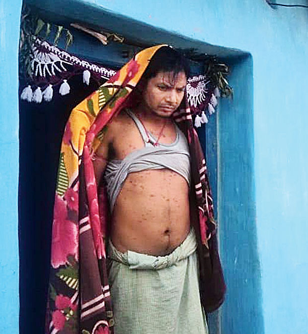 A chickenpox patient at Rangamatia village in Seraikela on Saturday
