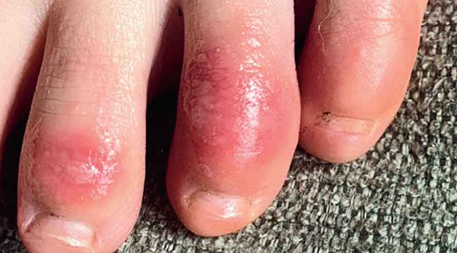The Covid toe on a white teenager