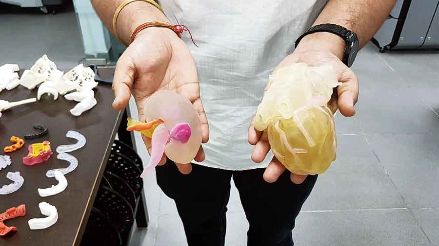 A 3D printed model of a diseased human kidney and heart that surgeons studied before operating on patients