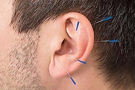 Auricular acupuncture (ear)