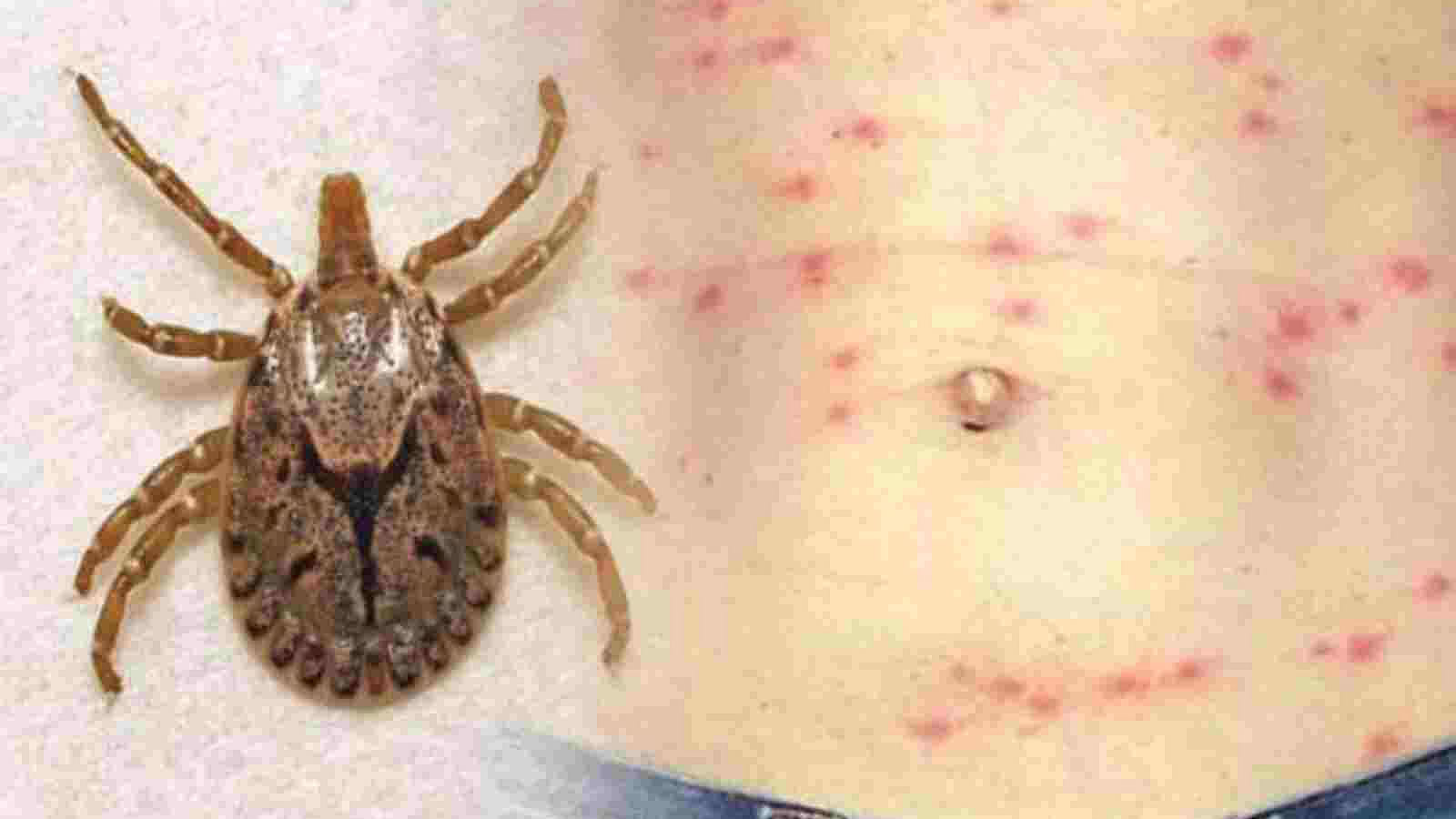 Scrub Typhus | Senior Physician Decodes the Mysteries of Scrub Typhus - Telegraph India