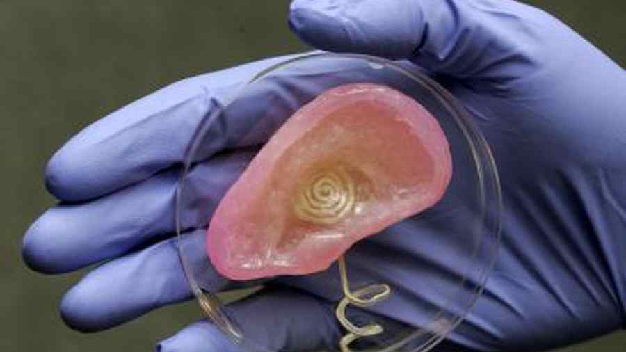 The new ear, transplanted in March, will continue to regenerate cartilage tissue, giving it the look and feel of a natural ear