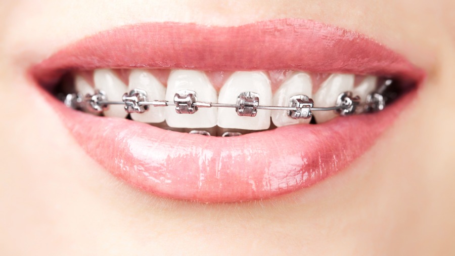 Apart from invisible braces, the other types of tooth aligners available are metal, ceramic and lingual