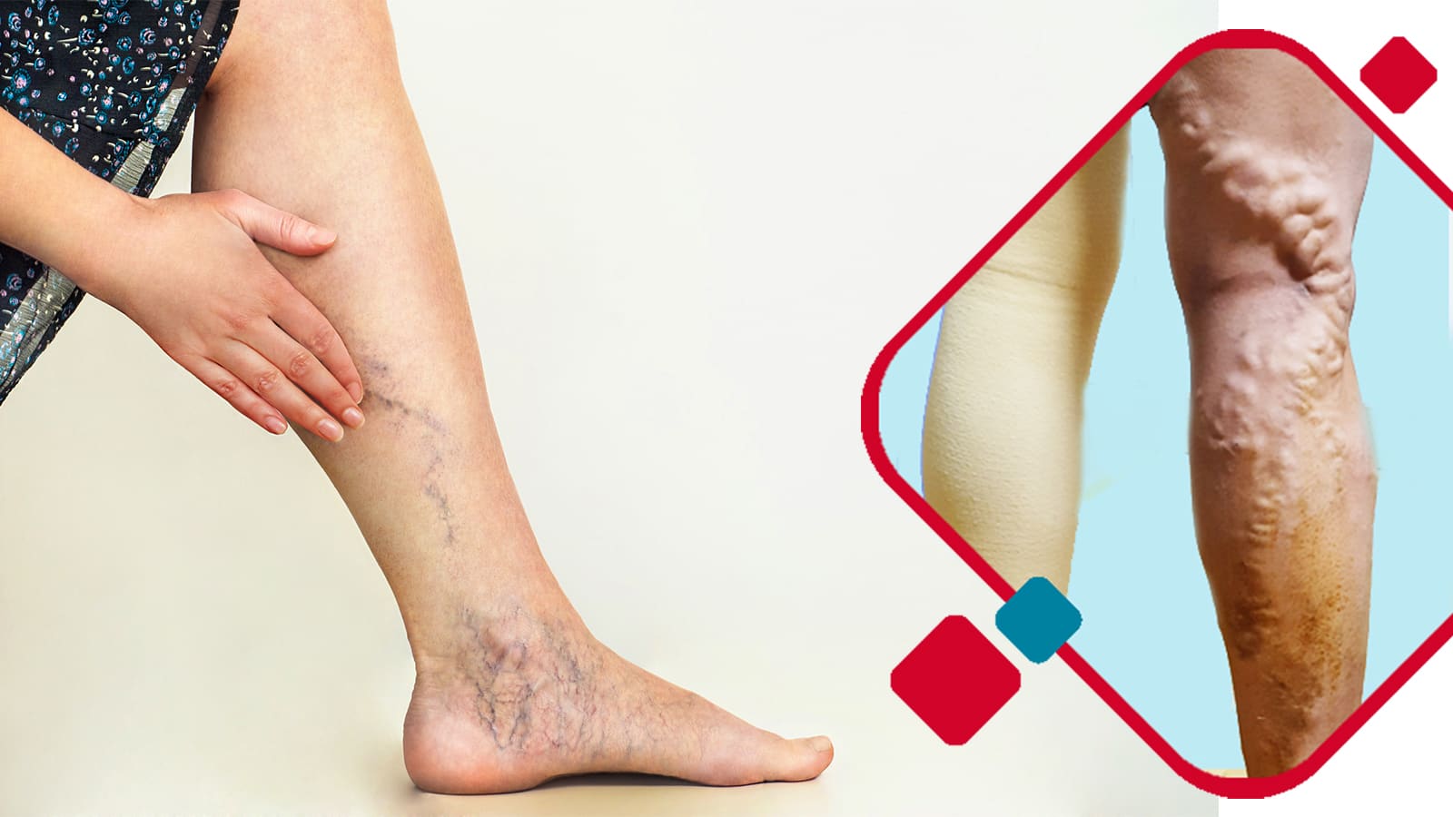 Five Ways to Completely Prevent Varicose Veins While Working